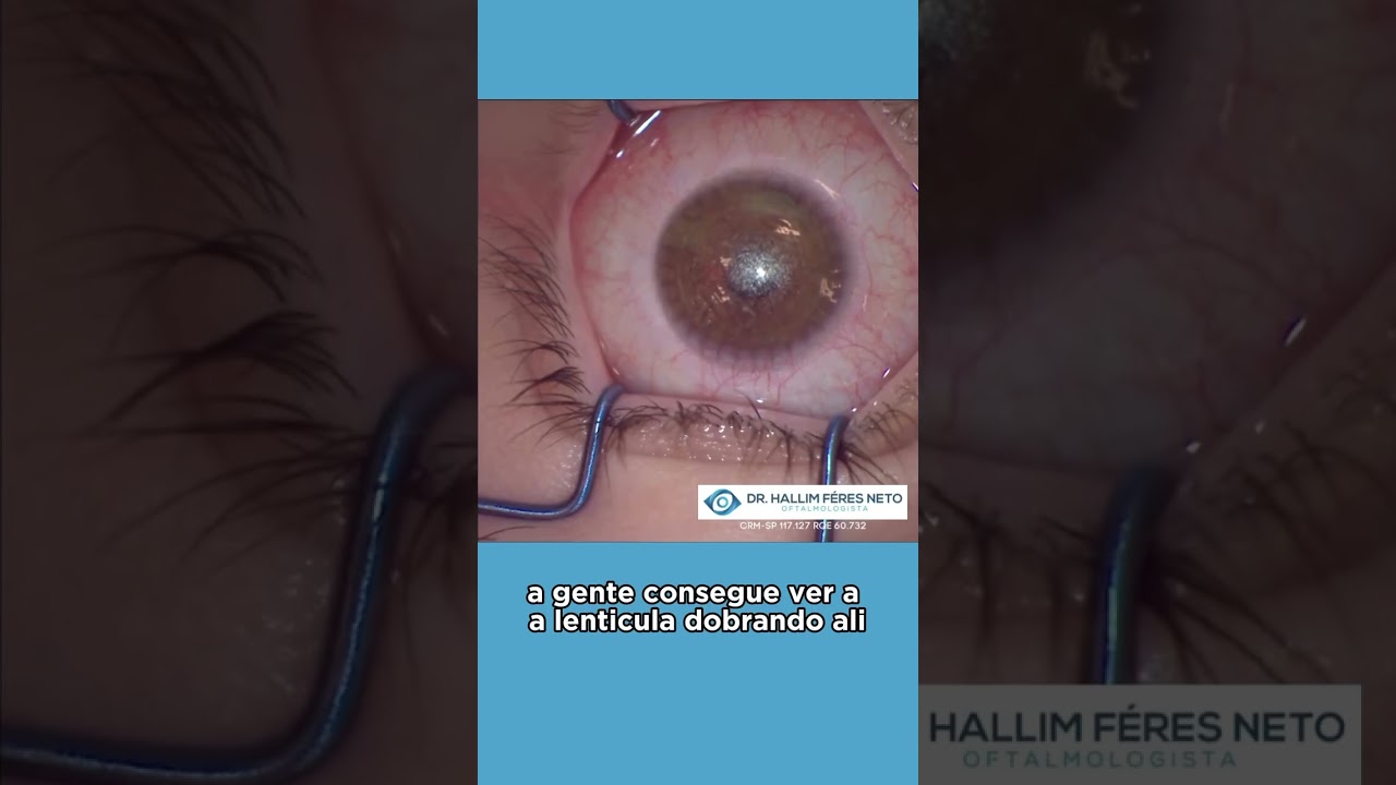 O futuro da correção visual: a técnica SMILE PRO, apenas no VisuMax 800