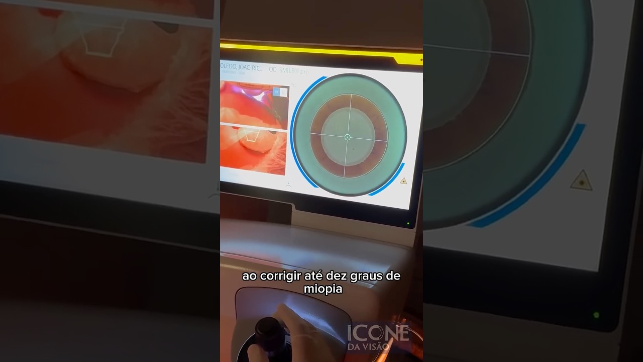 SMILE PRO: inovação a laser agora disponível em São Paulo