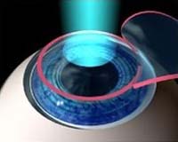 Cirurgia Refrativa LASIK
