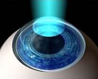 Cirurgia Refrativa PRK