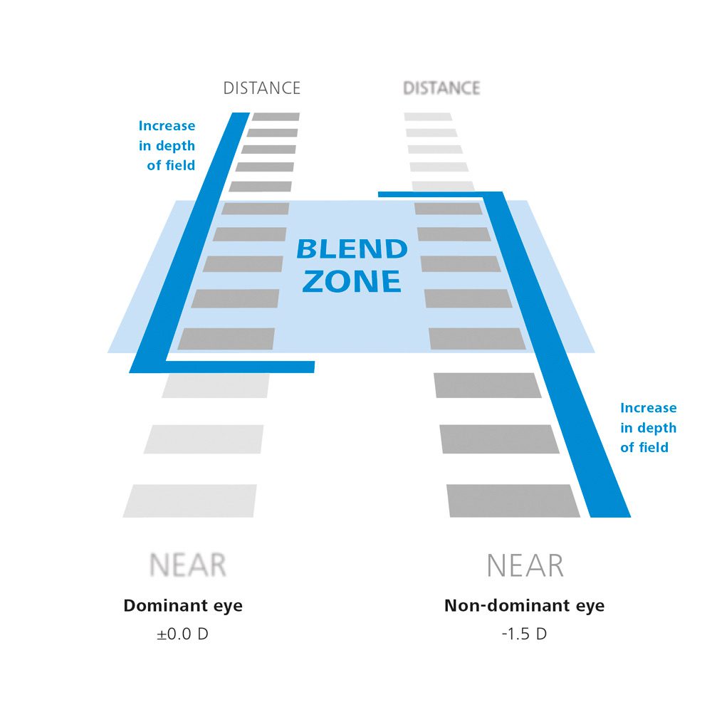Esquema do Presbyond Laser Blended Vision