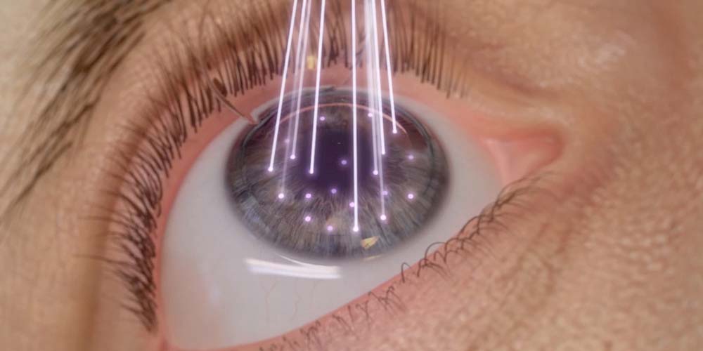 Dr Hallim - PRK Transepitelial