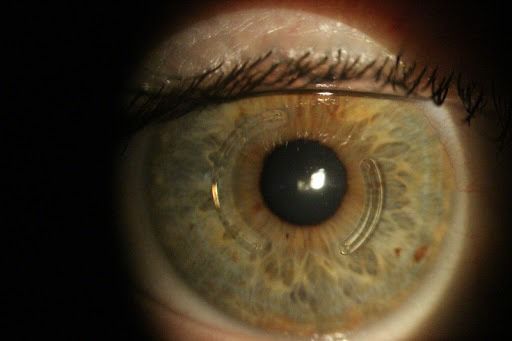 Imagem de olho com dois segmentos de anel intraestromal
