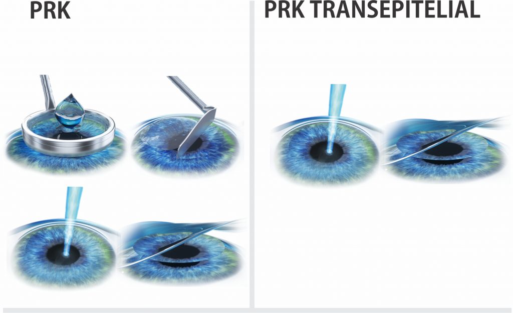 Diferença entre PRK Convencional e PRK Transepitelial
