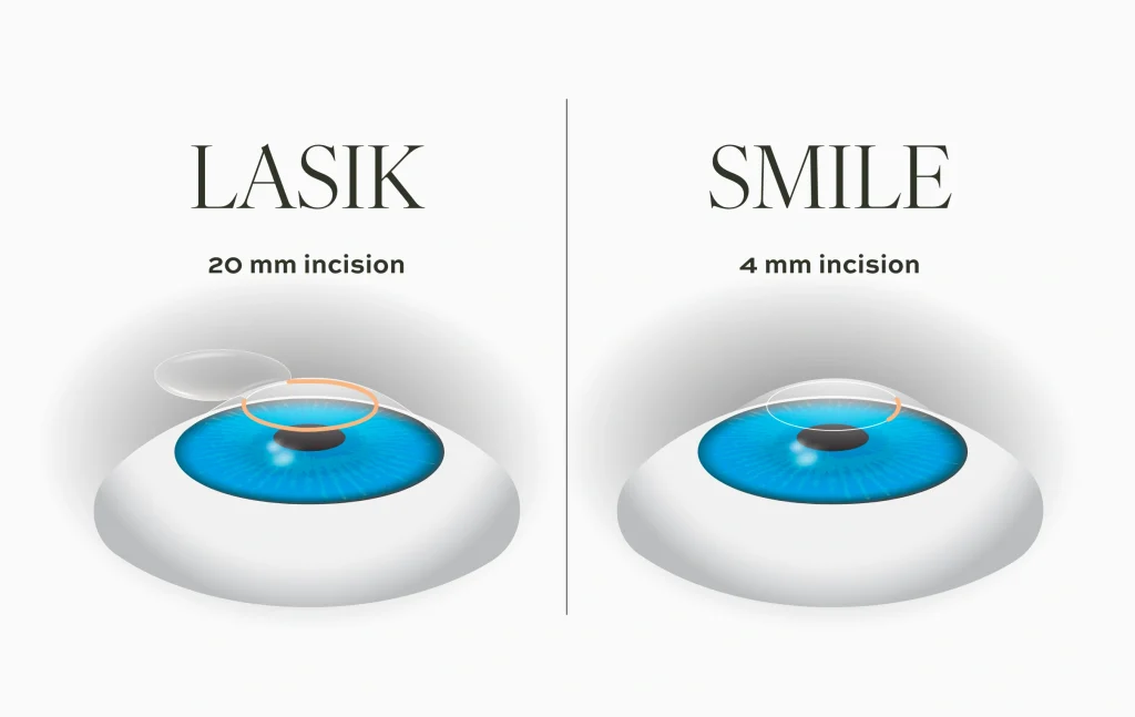 lasik vs smile