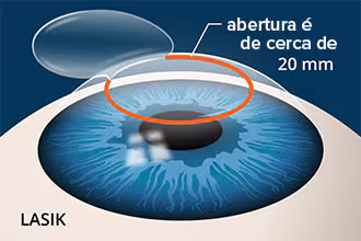 lasik20