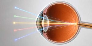 dr hallim feres neto cirurgia refrativa com ray tracing 01
