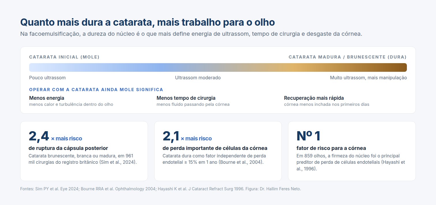 Quando operar catarata: quanto mais dura a catarata, mais ultrassom, mais tempo de cirurgia e mais risco de complicações, segundo os estudos