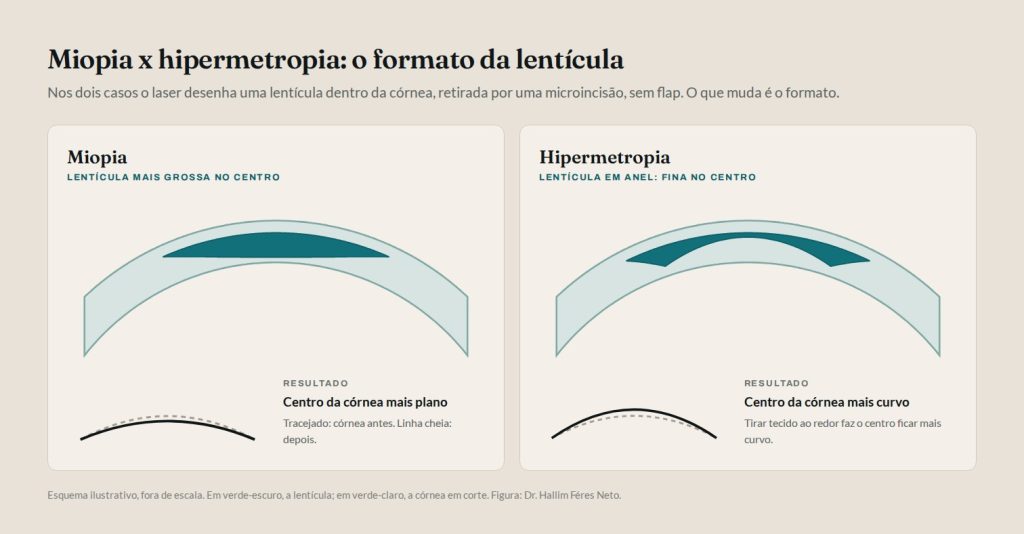SMILE para hipermetropia: comparação entre a lentícula da miopia, mais grossa no centro, e a lentícula em anel da hipermetropia, que deixa o centro da córnea mais curvo