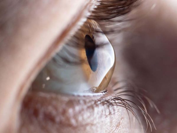 dr-hallim-feres-neto-ceratocone Dr Hallim Féres Neto Ceratocone